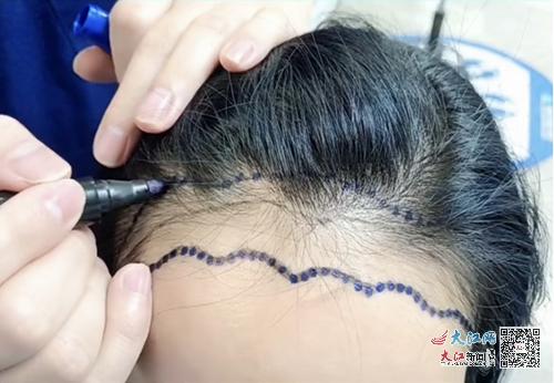 新生植发最新动态,全步骤指南及最新植发手术消息