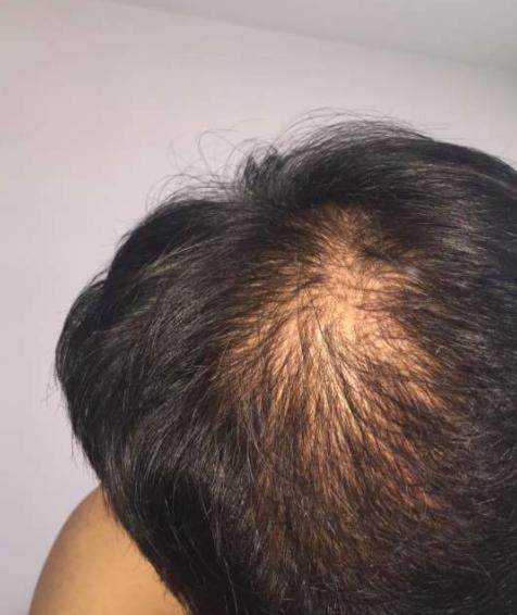 新生植发最新动态,全步骤指南及最新植发手术消息