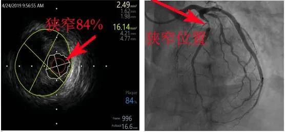 支架再狭窄研究最新进展概述